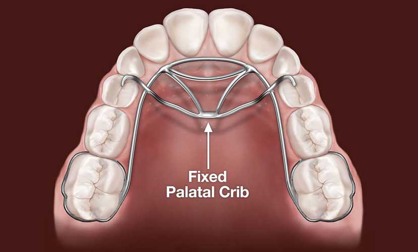 fixed_palatal_crib