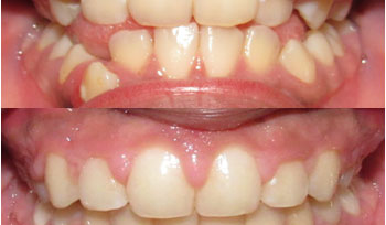 Before and after treatment photos of a patient