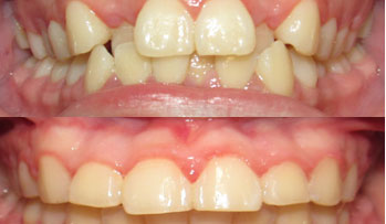 Before and after treatment photos of a patient